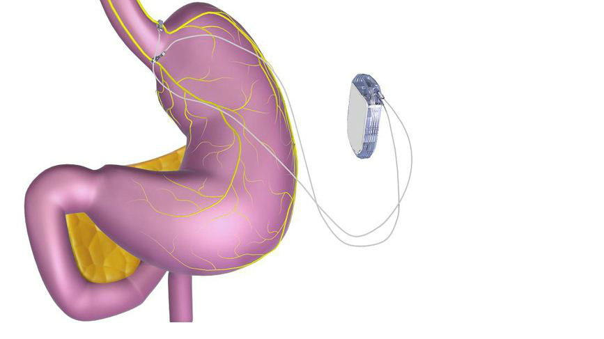 dispozitivul pentru slăbit 11