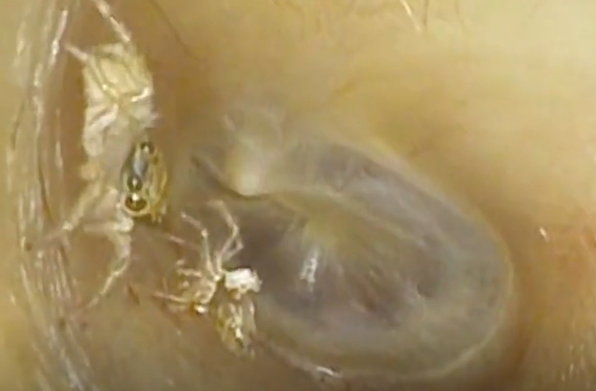 A simțit ceva ciudat într-o ureche și a ajuns la medic