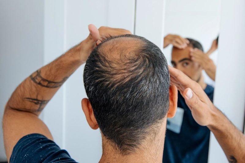 O nouă speranță pentru chelie: cercetătorii au crescut în laborator foliculi de păr funcționali