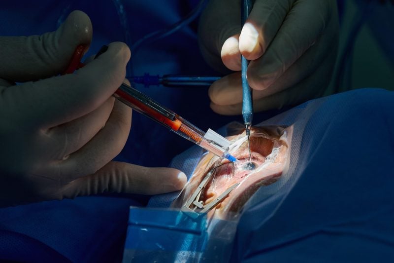 Premieră medicală: un chirurg a folosit Apple Vision Pro într-o operație de cataractă și schimbă modul în care medicii colaborează